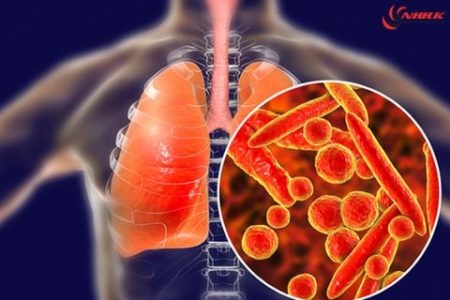 Bị lao phổi có đi Nhật Bản làm việc được không?